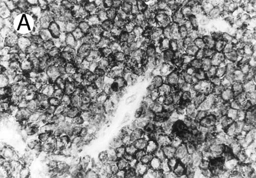 Fig. 2. ALCL of cytotoxic T-cell type with CD4 positivity (Table 2; case 3). (A) Paraffin section immunostain shows homogenous CD4 positivity in tumor cells. (B) Perforin positivity is shown in same case. (sABC-peroxidase technique, hematoxylin counterstain, original magnification × 400.)