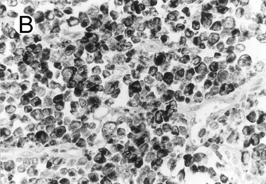 Fig. 2. ALCL of cytotoxic T-cell type with CD4 positivity (Table 2; case 3). (A) Paraffin section immunostain shows homogenous CD4 positivity in tumor cells. (B) Perforin positivity is shown in same case. (sABC-peroxidase technique, hematoxylin counterstain, original magnification × 400.)