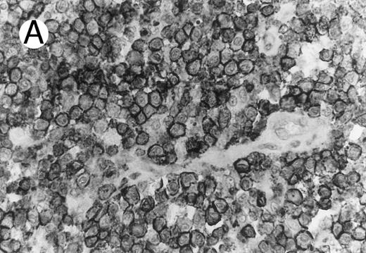 Fig. 3. ALCL of CD8+ cytotoxic T-cell type (Table 2; case 5). (A) Tumor cells display strong CD8 positivity in paraffin section. (B) Immunostain for TIA-1 reveals granular staining in the majority of tumor cells. (sABC-peroxidase technique, hematoxylin counterstain, original magnification × 400.)