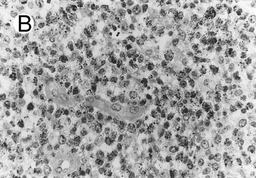 Fig. 3. ALCL of CD8+ cytotoxic T-cell type (Table 2; case 5). (A) Tumor cells display strong CD8 positivity in paraffin section. (B) Immunostain for TIA-1 reveals granular staining in the majority of tumor cells. (sABC-peroxidase technique, hematoxylin counterstain, original magnification × 400.)