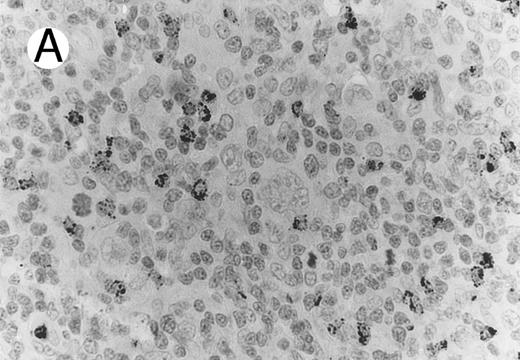 Fig. 4. Case of HD stained for cytotoxic granule proteins. (A) Numerous reactive lymphocytes display granular TIA-1 positivity, whereas tumor cells are negative. (B) Rare lymphocytes reveal perforin immunoreaction (arrows). (sABC-peroxidase technique, hematoxylin counterstain, original magnification × 400.)