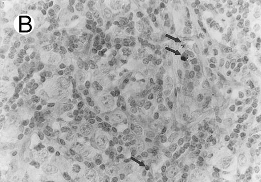 Fig. 4. Case of HD stained for cytotoxic granule proteins. (A) Numerous reactive lymphocytes display granular TIA-1 positivity, whereas tumor cells are negative. (B) Rare lymphocytes reveal perforin immunoreaction (arrows). (sABC-peroxidase technique, hematoxylin counterstain, original magnification × 400.)