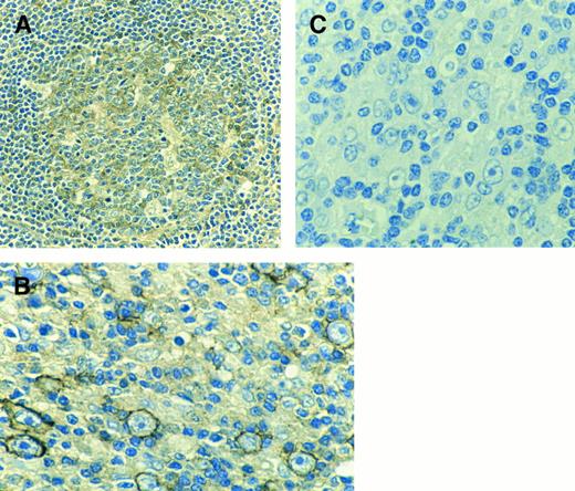 Fig. 2. (A) Immunohistochemical staining of the germinal center of a secondary follicle in a spleen with a polyclonal antibody directed to the C-terminal part of the c-MET receptor. (B) Example of centroblasts reacting with C-28 (anti c-MET) of an EMA+ lymph node from a patient with NHL. (C) As a negative control C-28 was preincubated with a 10-fold higher concentration of the peptide to which the antibody was raised (blocking peptide).