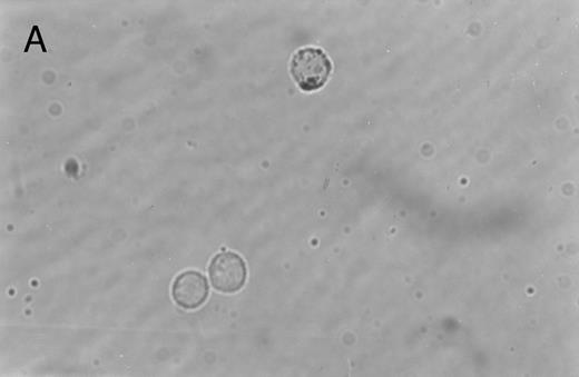 Fig. 2. Immunoperoxidase staining of of freshly isolated and cultured CML cells with anti-CD1a antibody. Freshly isolated (A) or 10-day cultured, nonadherent CML cells (B) were adhered to poly-l-lysine–coated coverslips and stained with anti-CD1a and peroxidase-conjugated antimouse IgG. Cells stained with isotype control antibody and peroxidase conjugate were similar to those depicted in (A) (data not shown).