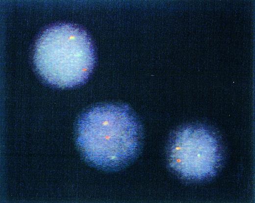 Fig. 4. Genotype of immunomagnetically enriched DCs. Most DCs from four patients studied exhibited one red (BCR) gene, one green (ABL) gene, and one yellow/orange (fused BCR-ABL) gene hybridization signal after FISH procedure. Representative cells from a single patient sample are depicted.