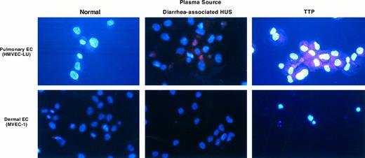 Fig. 3. UV light photography of microvascular EC stained with DAPI/sulforhodamine. Microvascular EC of pulmonary and dermal lineages were exposed to a 1:100 dilution of normal plasma or plasma from individuals with childhood/diarrhea-associated HUS or TTP for 18 hours. Cells were harvested and stained with DAPI and sulforhodamine 101, as described in the text. Apoptotic cells show DNA in two compartments: intense blue staining of fragmented nuclear material, (or apoptotic bodies) and dispersed DNA outside of the nucleus, inferred from the uniformity of the blue or violet (red/blue) hue of the cytoplasm. In contrast, intact cells show red cytoplasmic staining, with uniformly blue nuclei.