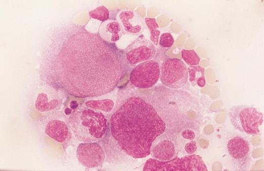 Parvovirus-induced red blood cell aplasia. A patient with hereditary spherocytosis presented with severe anemia and reticulocytopenia. The marrow showed giant pronormoblasts (with size comparable to that of megakaryocytes) and absence of normoblasts. The condition can be mistaken for marrow involvement by large-cell lymphoma. (Courtesy of K.F. Wong and J.K.C. Chan, Department of Pathology, Queen Elizabeth Hospital, Hong Kong.)