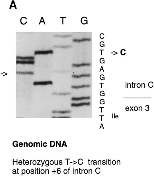 Fig. 3. Sequencing gels demonstrating the patients' DNA-mutation and the variant mRNA transcripts. (A) Sequencing of the patients' DNA shows a novel mutation, a heterozygous T → C transition at position +6 of intron C. (B) Sequencing of the RT-PCR product through exon 3/intron C boundary shows the incorporation of intronic sequence into the patients' mRNA and the T → C transition at position +6. * indicates altered amino acid sequence. (C) Sequencing of a truncated RT-PCR product in the antisense direction shows skipping of exon 3 (correct sequence in the boundary exons 2 and 3 is CAAG/AGTTT and exons 3 and 4 is ATTG/GTCGT.20 (D) Sequencing of a truncated RT-PCR-product shows skipping of exons 3 and 4 (correct sequence in the boundary of exons 4 and 5 is GAAG/ATGAG.20