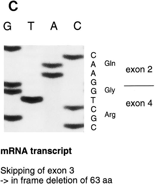 Fig. 3. Sequencing gels demonstrating the patients' DNA-mutation and the variant mRNA transcripts. (A) Sequencing of the patients' DNA shows a novel mutation, a heterozygous T → C transition at position +6 of intron C. (B) Sequencing of the RT-PCR product through exon 3/intron C boundary shows the incorporation of intronic sequence into the patients' mRNA and the T → C transition at position +6. * indicates altered amino acid sequence. (C) Sequencing of a truncated RT-PCR product in the antisense direction shows skipping of exon 3 (correct sequence in the boundary exons 2 and 3 is CAAG/AGTTT and exons 3 and 4 is ATTG/GTCGT.20 (D) Sequencing of a truncated RT-PCR-product shows skipping of exons 3 and 4 (correct sequence in the boundary of exons 4 and 5 is GAAG/ATGAG.20