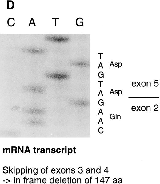 Fig. 3. Sequencing gels demonstrating the patients' DNA-mutation and the variant mRNA transcripts. (A) Sequencing of the patients' DNA shows a novel mutation, a heterozygous T → C transition at position +6 of intron C. (B) Sequencing of the RT-PCR product through exon 3/intron C boundary shows the incorporation of intronic sequence into the patients' mRNA and the T → C transition at position +6. * indicates altered amino acid sequence. (C) Sequencing of a truncated RT-PCR product in the antisense direction shows skipping of exon 3 (correct sequence in the boundary exons 2 and 3 is CAAG/AGTTT and exons 3 and 4 is ATTG/GTCGT.20 (D) Sequencing of a truncated RT-PCR-product shows skipping of exons 3 and 4 (correct sequence in the boundary of exons 4 and 5 is GAAG/ATGAG.20