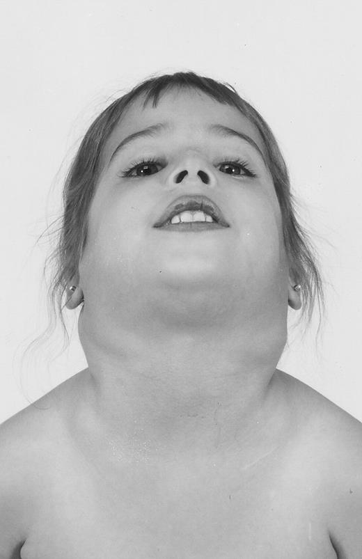 Fig. 1. Photograph of patient no. 2 showing 4+ cervical adenopathy.