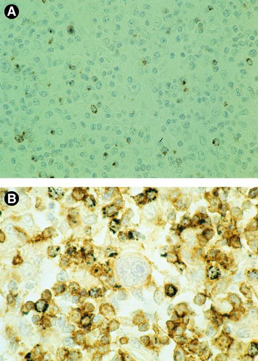Fig. 1. (A) Detection of GrB+ lymphocytes is shown. A biopsy specimen of an HD patient with ≥15% GrB+ cells, presenting with stage-2 disease who died 45 months later as a result of the disease, is shown. Brown cytoplasmic staining indicates GrB expression. (B) Double-staining for CD8 and GrB is shown. The majority of reactive lymphocytes present in the vicinity of the RS cell in the center are CD8+ (brown membranous staining). Black cytoplasmic staining shows that many of these CD8+ cells also express GrB. GrB+/CD8− cells are not observed. Thus, the large majority of GrB+ cells should be considered activated CTLs.