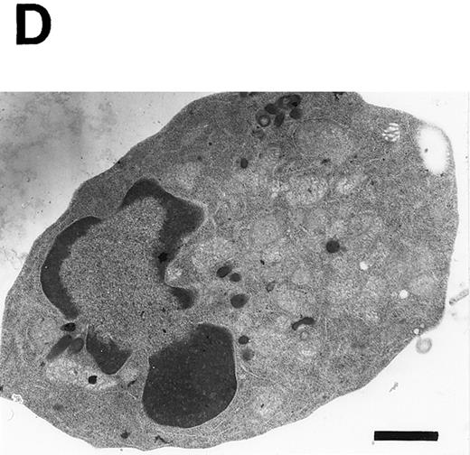 Fig. 4. Induction of apoptosis in PU.1-overexpressing cells. (A) Morphology of PU.1-sense clone 1 cells cultured in the ordinary medium. (B) Morphology of the same cells cultured with 1.5% DMSO and 100 μmol/L ZnCl2 for 48 hours. Arrows point to the flat cells attaching to the bottom of culture dishes, arrowheads to the spindle-like cells, and arrows with an asterisk to the dead cells. (C) DNA fragmentation analysis of the parental MEL-B8/3 cells and transfectants cultured under various conditions. DNA was extracted from the cells cultured for 48 hours in the ordinary medium or in the medium containing 1.5% DMSO and/or 100 μmol/L ZnCl2 and was electrophoresed in a 1.5% agarose gel. (D) The ultrastructural appearance of a PU.1-sense clone 1 cell showing characteristic features of apoptosis after 48 hours of culture with 1.5% DMSO and 100 μmol/L ZnCl2 . Note the dense chromatin aggregation under the nuclear membrane and no remarkable changes of the mitochondria and other organelles. Scale bar, 1 μm.