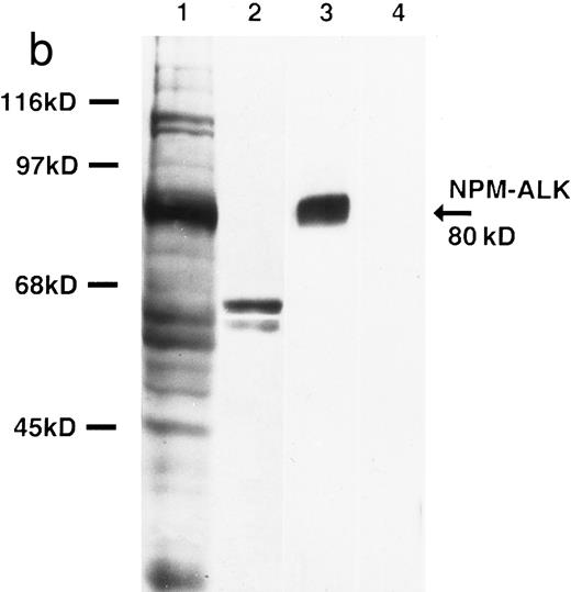 Fig. 2. Biochemical characterization of antibody ALK1. (a) Cell lysates were separated by SDS-PAGE and then subjected to Western blotting. Antibody ALK1 recognizes a protein of 80 kD in the t(2; 5)+ SU-DHL-1 cell line (lane 1). No protein bands are detected in the Daudi B-cell line or the Hodgkin's-derived cell lines L540, L428, HDLM-2, and KM-H2 (lanes 2 through 6). However, antibody ALK1 did detect a band of 200 kD in lysates of the human rhabdomyosarcoma Rh30 cell line (lane 7) that expresses the full-length ALK receptor protein19 and in 293T (human embryonic kidney epithelial) cells that had been transfected with a cDNA encoding the full-length ALK protein (lane 8). No bands were seen in 293T cells that had been tranfected with pcDNA3 vector only (lane 9). The smaller bands seen in the lysates from the SU-DHL-1 and 293T cells transfected with pcDNA3-ALK have been observed using polyclonal anti-ALK sera ( S.W. Morris, personal communication, March 1996) and probably represent proteolytic breakdown products of the NPM-ALK and ALK proteins, respectively. (b) Immunoprecipitates prepared from SU-DHL-1 and Daudi cell lysates using the antiphosphotyrosine antibody 4G10 were subjected to SDS-PAGE and then electroblotted. The blots were then stained with either the antiphosphotyrosine antibody 4G10 (lanes 1 and 2) or with antibody ALK1 (lanes 3 and 4). The t(2; 5)+ SU-DHL-1 cell line contained many phosphorylated proteins (lane 1) in contrast to only two found in the Daudi cell line (lane 2). Antibody ALK1 labeled only the prominent 80-kD phosphorylated NPM-ALK protein present in the SU-DHL-1 cells (lane 3). No bands were detected by antibody ALK1 in the Daudi cell immunoprecipitate (lane 4). The position of molecular weight standards (myosin, 205 kD; galactosidase, 116 kD; phosphorylase, 97 kD; bovine serum albumin, 68 kD; and ovalbumin, 45 kD) are indicated.