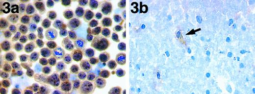 Fig. 3. (a) Immunoperoxidase labeling of the t(2; 5)+ cell line with antibody ALK1. The nuclei, cytoplasm, and nucleoli are strongly labeled by antibody ALK1. During mitosis, the staining of these cells becomes cytoplasmic. (b) Immunoperoxidase labeling of a cryostat section of basal ganglia showing weak labeling of a glial cell (arrow).