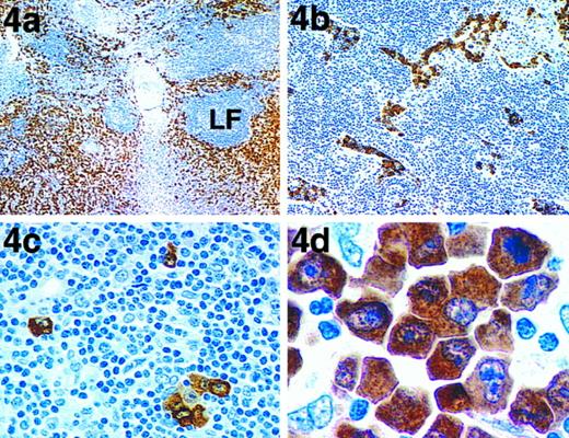 Fig. 4. Immunoperoxidase labeling of a paraffin-embedded lymph node section from a case of ALCL. (a) Low-power view showing areas of tumor infiltration. LF, a residual lymphoid follicle surrounded by malignant cells. The lack of staining of normal cells allows scattered malignant cells to be easily detected in (b) lymphatic sinuses or as (c) isolated cells. (d) At higher power, antibody ALK1 labels both the cytoplasm and, more variably, the nuclei of the malignant cells.