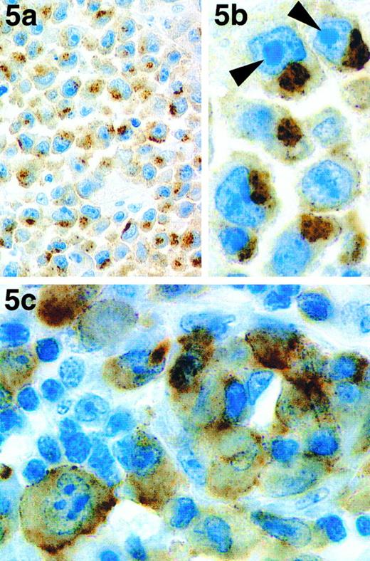 Fig. 5. Immunoperoxidase labeling of paraffin-embedded sections of 2 atypical cases of ALCL. One of the three cases of CD30− ALCL that were labeled by antibody ALK1 is shown at low power (a) and high (b) magnification. Staining is in the form of coarse granules in the cytoplasm that tend to be localized to the paranuclear area. The prominent nucleoli (characteristic of these 3 cases) are indicated with arrows. (c) The neoplastic cells in a case of ALCL carrying a 1; 2 translocation are clearly labeled by antibody ALK1.