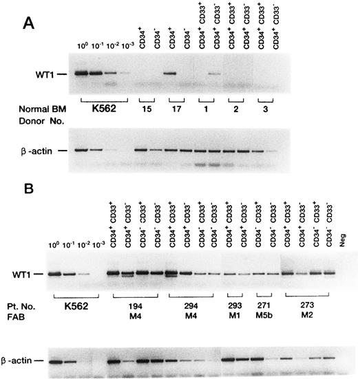Fig. 2. Expression of the WT1 gene in FACS-sorted normal BM (A) or leukemic (B) cells. Representative cases are shown. To detect WT1 mRNA, PCR was performed for 45 cycles (35 and 10 cycles for first and second round PCR, respectively). To quantitate β-actin mRNA, PCR was performed for 31 cycles.