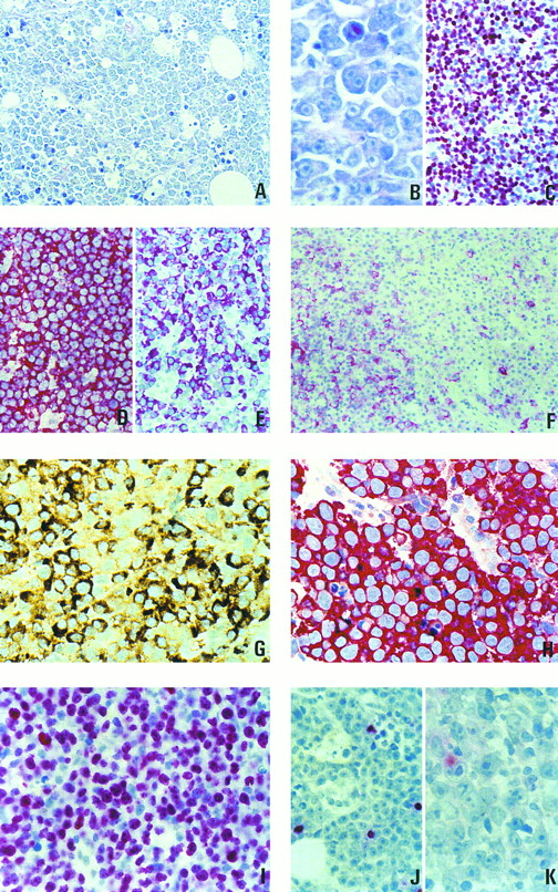 Fig. 1. (A through C) Morphology and proliferation index of 1 case of plasmablastic lymphoma. (A) Giemsa staining, original magnification × 400. (B) Giemsa staining, original magnification × 800. (C) Staining with the Ki-67–specific antibody MIB-1. (D through F ) Paraffin sections of lymph nodes from patients with large-cell lymphomas stained for B-cell–specific antigens. (D) Large-cell lymphoma of the common type, L26 antibody, strong membrane staining in all cells. (E) Plasmablastic lymphoma, strong staining for CD79a (JCB117). (F ) Plasmablastic lymphoma, with an unusually high number of cells showing membranous staining with the L26 antibody. (G) Paraffin section from a plasmablastic lymphoma. Intense staining for IgG. (H) Paraffin section from a plasmablastic lymphoma. All neoplastic cells are strongly labeled by the antibody VS38c. (I through K) Association of plasmablastic lymphomas with EBV and expression of viral latent proteins. (I) In situ hybridization for EBER transcripts. (J) Immunostaining with an antibody specific to the viral BZLF-1 protein. (K) Immunostaining with an antibody specific to viral LMP-1.