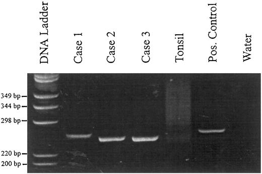 Fig. 2. Evaluation of the clonality of PBL by PCR. Amplification products after IgH-PCR and PAGE (6% polyacrylamide gel, staining with ethidium bromide). Case no. 1, tumor of patient no. 12; case no. 2, tumor of patient no. 15; case no. 3, tumor of patient no. 9; positive control, DNA extracted from the Raji cell line.