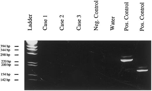 Fig. 3. Absence of bcl-2 rearrangements in PBL, (6% polyacrylamide gel, staining with ethidium bromide). Case no. 1, tumor of patient no. 12; case no. 2, tumor of patient no. 15; case no. 3, tumor of patient no. 9; negative control, DNA extracted from a tonsil; positive controls, 2 cases of follicle center lymphomas.