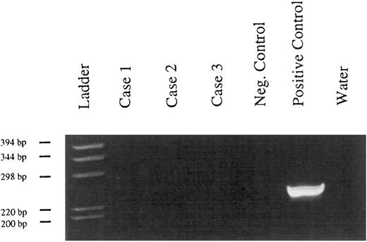 Fig. 4. Absence of Kaposi's sarcoma-associated herpesvirus DNA from PBL. (PCR, 6% polyacrylamide gel, staining with ethidium bromide). Case no. 1, tumor of patient no. 12; case no. 2, tumor of patient no. 15; case no. 3, tumor of patient no. 9; negative control, DNA extracted from a tonsil; positive control, Kaposi's sarcoma.
