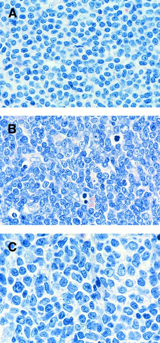 Fig. 1. The cytomorphologic spectrum of MCL. (A) Common variant, (B) lymphoblastoid variant, and (C) pleomorphic variant of MCL. Note the same amount of magnification (×1,000) in (A), (B), and (C).