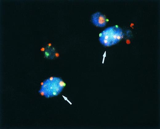 Fig. 2. Bicolor FISH in a pleomorphic variant of MCL. Note four red signals for chromosome 7 and two green signals for chromosome X in two cells (arrows) of a male patient, indicating a tetraploid chromosome clone.