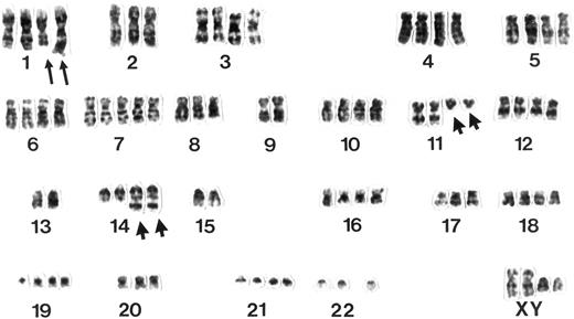 Fig. 3. Example of a G-banded karyotype from a pleomorphic variant of MCL. Note two rearranged chromosomes 11 and 14 displaying a t(11; 14)(q13;q32) and additional structural aberrations in the long arms of two chromosomes 1 next to a polysomy for chromosome 7.