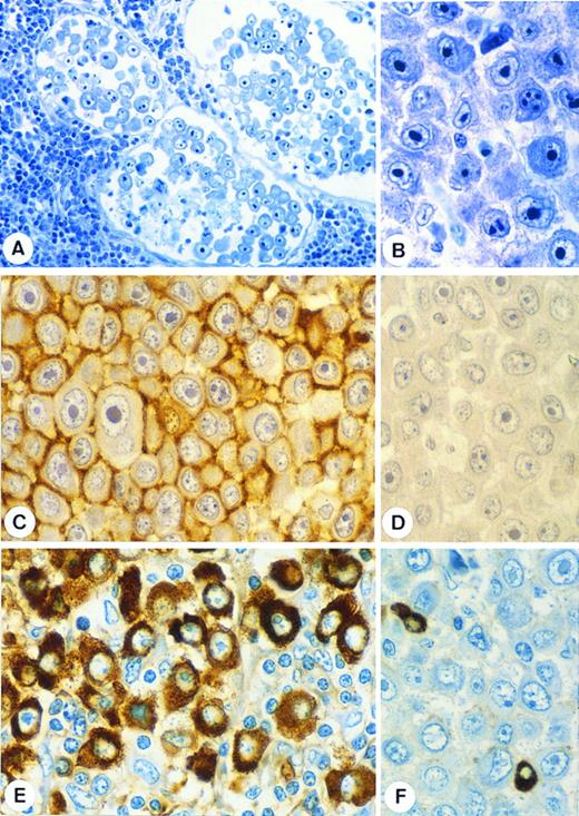 Fig. 1. Morphologic and phenotypic features of the lymphomas described in this report. (A and B) Characteristic sinusoidal growth pattern and cellular morphology (Giemsa stain). (C through F ) Immunostaining reactions. EMA is strongly expressed (C) but CD30 is absent (D). Neoplastic cells express IgA (E) but in a section stained for IgM (F ) only plasma cells are stained. (Immunoperoxidase staining with nuclear counterstain.)