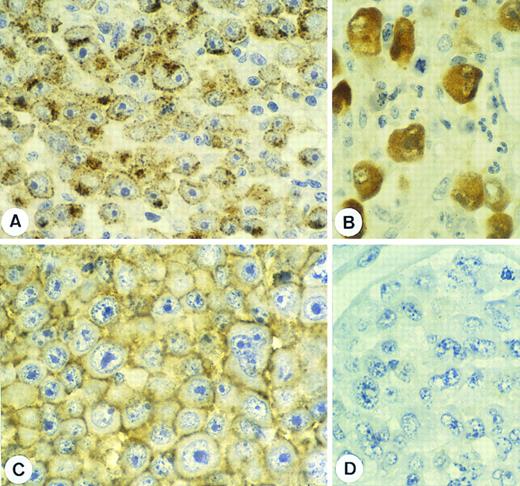 Fig. 2. Expression of ALK protein. (A) Staining for the intracellular portion of ALK protein (antibody ALK1) is seen as granular cytoplasmic staining associated with a dot-like reaction in the Golgi area. (B) The same antibody gives a diffuse cytoplasmic and nuclear labeling of a classical ALCL expressing the chimeric NPM-ALK protein. (C) Staining with an antibody (ALK-EC) against the extracellular portion of the ALK molecule shows a membrane associated labeling pattern. (D) A classical ALCL case expressing NPM-ALK is negative with this antibody (immunoperoxidase staining with nuclear counterstain).