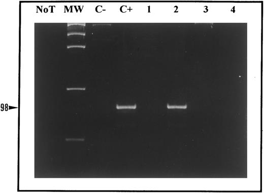 Fig. 3. RT-PCR with primers detecting NPM-ALK transcripts. Total mRNAs extracted from the t(2; 5)-bearing SU-DHL1 cell line (lane C+) and a t(2; 5)-positive case of ALCL (lane 2) yield the expected band of 98 bp. RNAs from the CEM T-cell line (C−), a t(2; 5)-negative ALCL (lane 1) and from two tumors under study (cases 1 and 6) (lanes 3 and 4) are negative for hybrid NPM-ALK mRNA. NoT, no template cDNA; MW, molecular-weight markers.
