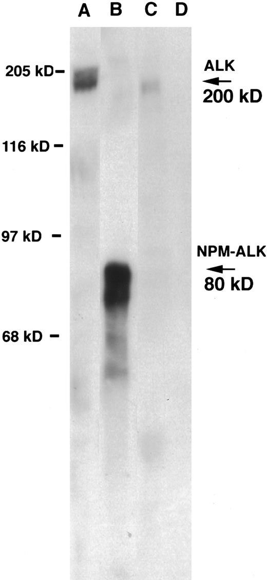 Fig. 5. Western blotting with antibody ALK1. Antibody ALK1 recognizes a protein of 200 kD, corresponding to the normal ALK receptor, in the Rh30 rhabdomyosarcoma cell line (lane A), whereas only a smaller band of 80 kD, representing NPM-ALK, is detected in the t(2; 5)-positive Karpas 299 cell line (lane B). The antibody also detects the 200-kD ALK protein in cells from case 1 (lane C). The negative control (normal tonsil) is shown in lane D.