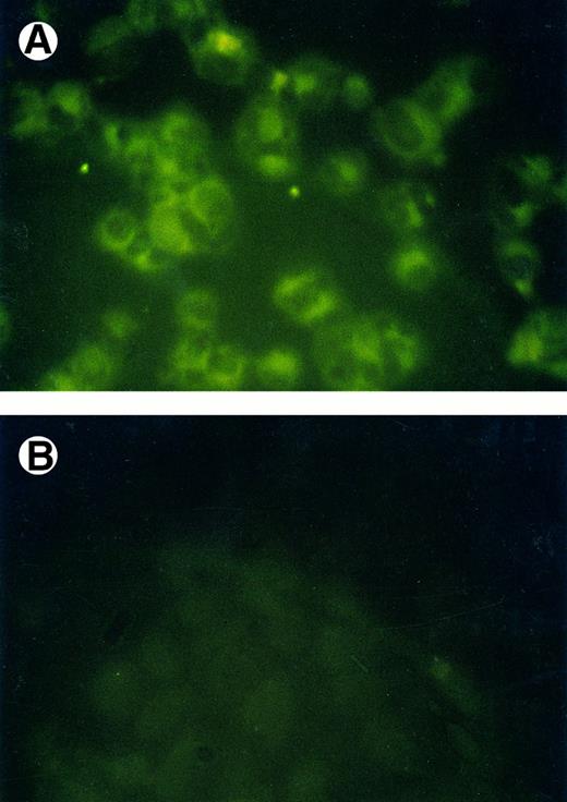 Fig. 1. GR expression in KS cells. GR was studied by immunofluorescence staining using (A) rabbit polyconal antibodies to synthetic peptides to the amino terminus of GR at concentrations of 1:50. (B) Preimmune rabbit serum was used at equal dilution to show the specificity of the antibodies.