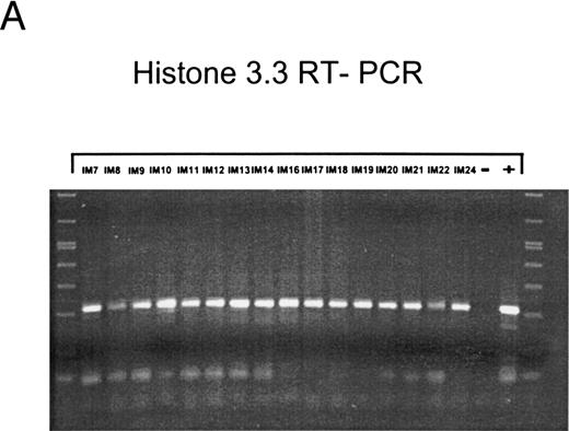 Fig. 2. Nested PCR screening and probe hybridization for BZLF1 (B), BRLF1 (C), BALF2 (D), and BcLF1 (E) in RNA preparations from freshly prepared and enriched B cells of IM patients. RNA from 2 × 106 cells was used as a template. Before the EBV-specific PCR, RNA quality was controlled by histone 3.3 RT-PCR (A).41 Positive controls were performed with 2 × 104 PMA-treated P3HR1/16 cells for BRLF1 and 2 × 106 untreated B95-8 cells for BZLF1, BALF2, and BcLF1 RT-PCR and nested PCR. For negative controls, we used 2 × 106 EBV-negative BJAB cells.