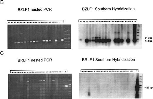 Fig. 2. Nested PCR screening and probe hybridization for BZLF1 (B), BRLF1 (C), BALF2 (D), and BcLF1 (E) in RNA preparations from freshly prepared and enriched B cells of IM patients. RNA from 2 × 106 cells was used as a template. Before the EBV-specific PCR, RNA quality was controlled by histone 3.3 RT-PCR (A).41 Positive controls were performed with 2 × 104 PMA-treated P3HR1/16 cells for BRLF1 and 2 × 106 untreated B95-8 cells for BZLF1, BALF2, and BcLF1 RT-PCR and nested PCR. For negative controls, we used 2 × 106 EBV-negative BJAB cells.
