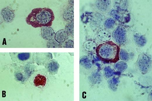 Fig. 3. Positive staining of B lymphocytes with monoclonal antibodies against EBV antigens EA (A), BZLF1 (B), and VCA (C) by immunostaining with the APAAP technique (original magnification × 1,000).