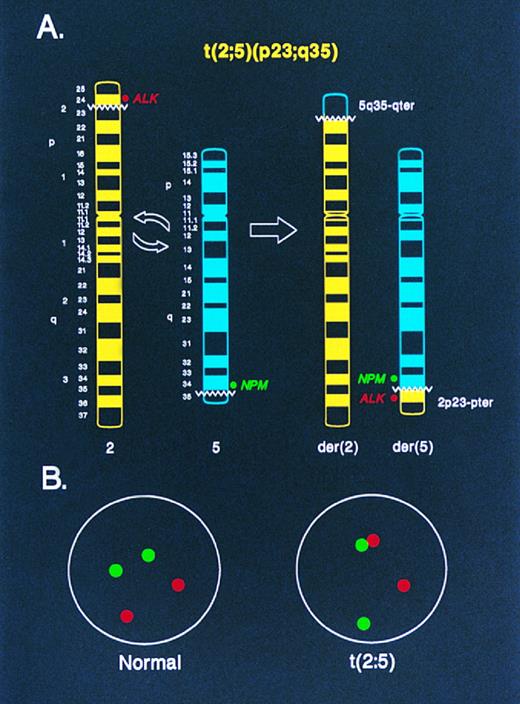 Fig. 1. Diagrammatic representation of two-color NPM-ALK FISH in the analysis of (A) metaphase chromosomes and (B) interphase nuclei. In (A), an idiogram of normal chromosomes 2 and 5, and the derivative chromosomes 2 and 5 produced by the t(2; 5), is shown. The location of the ALK and NPM DNA probes used for FISH in this study relative to the t(2; 5) breakpoints on the normal chromosomes 2 and 5, respectively, is indicated. Juxtaposition of the green (NPM ) and red (ALK ) fluorescent signals in a metaphase preparation identifies the der(5) chromosome, which encodes the oncogenic NPM-ALK fusion protein. In (B), the random spacing of NPM (green) and ALK (red) fluorescent signals in a normal diploid interphase nucleus is shown. In nuclei from cells containing the t(2; 5), the chromatin strands representing the der(5)-encoded NPM-ALK fusion gene are apparent as paired green and red signals or as yellow “fusion” signals resulting from overlapping green and red fluorescence.