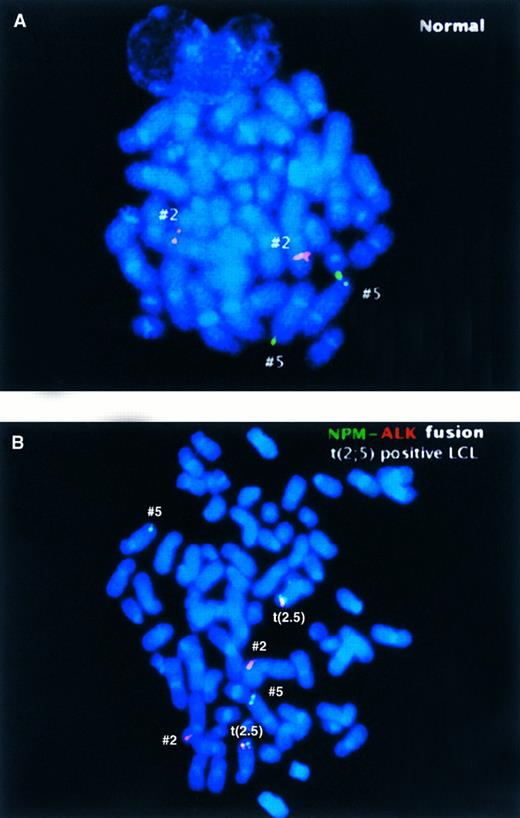 Fig. 2. Two-color NPM-ALK FISH assay of (A) a normal metaphase chromosome preparation illustrating the hybridization pattern of the ALK (red) and NPM (green) probes to normal chromosomes 2 and 5, respectively, and (B) a metaphase preparation from a t(2; 5)-positive LCL showing the paired red and green, or yellow fusion, signals present on the der(5) produced by the translocation, in addition to the nonpaired green or red signals present on the nonrearranged chromosomes.