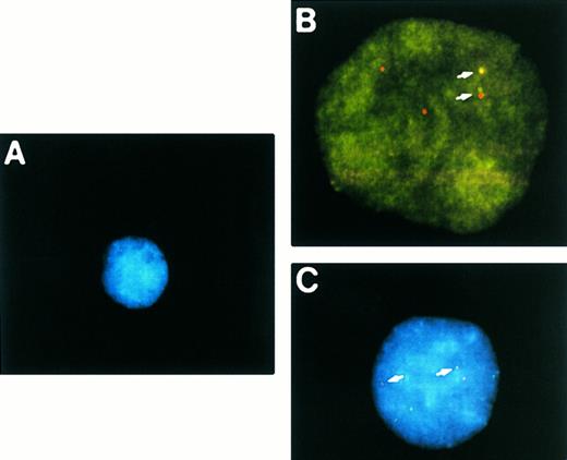 Fig. 3. Analysis of interphase nuclei using two-color NPM-ALK FISH. (A) Normal PB lymphocyte nucleus showing nonpaired, randomly spaced green and red fluorescent signals. (B) Interphase nucleus from the t(2; 5)-positive cell line SUP-M2 illustrating a yellow fusion signal produced by overlapping NPM and ALK DNA probes (upper arrow), as well as paired green and red fluorescent signals (lower arrow) produced by juxtaposition of the probes on the der(5) chromatin strands. (C) A representative interphase nucleus from the analysis of a t(2; 5)-positive clinical sample is shown (case no. 932499). Overlapping (yellow) and paired (green and red) signals (arrows) indicating the der(5) of the t(2; 5) are seen in this translocation-positive NHL sample. The nuclei in (A) and (C) were counterstained with DAPI which produces a blue background; (B) was photographed from a preparation that was not counterstained.