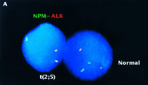 Fig. 4. Two-color NPM-ALK FISH of t(2; 5)-positive (A) and -negative (B,C) NHL samples. (A) Interphase nuclei prepared from the bone marrow of a t(2; 5)-positive NHL case (accession number 931737) showing adjacent translocation-containing and normal nuclei. (B) Metaphase chromosome preparation from a t(2; 5)-negative NHL illustrating the lack of pairing of green and red signals in an aneuploid tumor. (C) Interphase nuclei prepared from the same tumor as shown in (B) showing the presence of multiple chromosomes 2 and 5 but the absence of the der(5) produced by the t(2; 5). This case (accession number 921332) was initially thought to be t(2; 5)-positive based on classical cytogenetic analysis that revealed an abnormality of distal 2p.