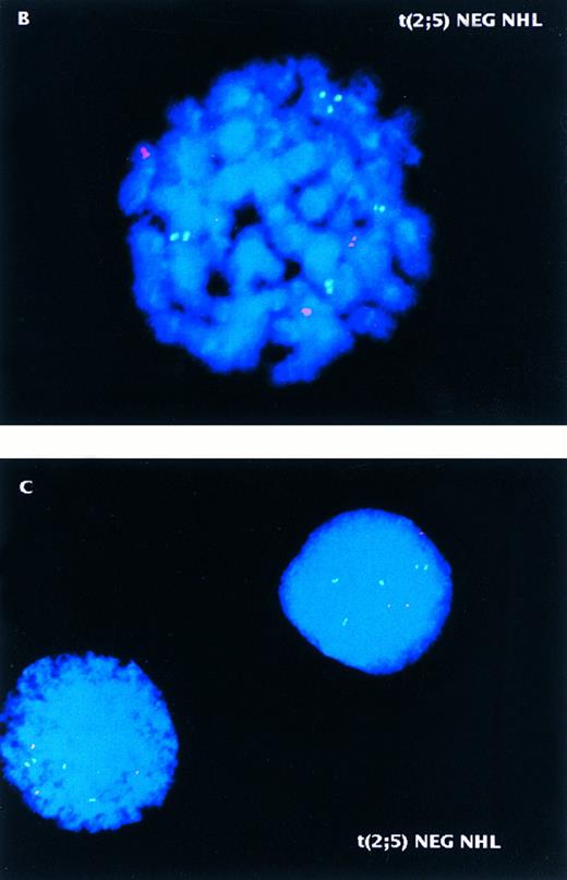 Fig. 4. Two-color NPM-ALK FISH of t(2; 5)-positive (A) and -negative (B,C) NHL samples. (A) Interphase nuclei prepared from the bone marrow of a t(2; 5)-positive NHL case (accession number 931737) showing adjacent translocation-containing and normal nuclei. (B) Metaphase chromosome preparation from a t(2; 5)-negative NHL illustrating the lack of pairing of green and red signals in an aneuploid tumor. (C) Interphase nuclei prepared from the same tumor as shown in (B) showing the presence of multiple chromosomes 2 and 5 but the absence of the der(5) produced by the t(2; 5). This case (accession number 921332) was initially thought to be t(2; 5)-positive based on classical cytogenetic analysis that revealed an abnormality of distal 2p.
