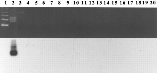 Fig. 3. Nested PCR analysis for KSHV sequences from DNA of urogenital specimens from Italian and American individuals. Lane 1, 100-base pair (bp) molecular weight ladder. Lane 2, 0.01% KS-1 cell line DNA diluted in K562 DNA served as a positive control. The 160-bp band represents the nest-primer product; the two upper bands represent fragments derived from the internal and external primer sets. Lane 3, 100% K562 DNA served as a negative control. Lanes 4 through 13 were DNA samples from normal prostate tissue from Italian men. Lanes 14 through 20 were DNA samples from normal prostate tissue from patients from the United States.