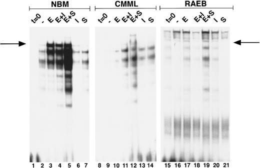 Fig. 2. Induction of GATA-binding in MDS and NBM. Cells were obtained and extracted at t = 0 (lanes 1, 8, 15), and after culture for 3 days with no factor (lanes 2, 9, 16) Epo (lanes 3, 10, 17), Epo + IL-3 (lanes 4, 11, 18) Epo + SCF (lanes 5, 12, 19), IL-3 (lanes 6, 13, 20), and SCF (lanes 7, 14, 21). Nuclear extracts of equivalent amounts of marrow cells from two MDS patients (no. 19, CMML; and no. 7, RAEB) and one NBM were incubated with the β-globin probe and run on a nondenaturing polyacrylamide gel. Position of the GATA-1–probe complex (as determined from co-runs with extracts from GATA-1–expressing cell lines) is indicated with an arrow. Lower bands are caused by binding of GATA-1 proteolytic fragments generated during culture and sample preparation. Lanes 15 through 21 are relatively overexposed as compared with lanes 1 through 14.