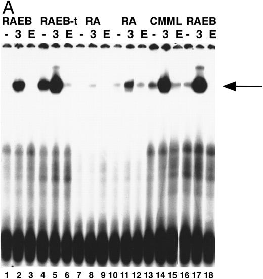 Fig. 4. (A) STAT5 activation in MDS patients cells after incubation with Epo. Equivalent amounts of cells were obtained and extracted after 15 minutes of incubation without factor (lanes 1, 4, 7, 10, 13, 16), with IL-3 (lanes 2, 5, 8, 11, 14, 17), or with Epo (lanes 3, 6, 9, 12, 15, 18). Marrow cells used were obtained from patient 8 (lanes 1 through 3), patient 13 (lanes 4 through 6), patient 2 (lanes 7 through 9), patient 1 (lanes 10 through 12), patient 19 (lanes 13 through 15), patient 7 (lanes 16 through 18); patient numbers correlate to case numbers in Table 1. Nuclear extracts were incubated with the β-casein probe. Arrow indicates position of STAT5 complex. (B) Activation of STAT5 in MDS at different time points. Cells from two patients with MDS (patient 13, lanes 1 through 7; and patient 8, lanes 8 through 14) were obtained and extracted after no stimulation (lanes 1 and 8), or after incubation with Epo for 5 (lanes 2 and 9), 15 (lanes 3 and 10), 30 (lanes 4 and 11), 60 (lanes 5 and 12), or 180 minutes (lanes 6 and 13), or after incubation for 15 minutes with IL-3 (lanes 7 and 14). The probe used is the β-casein probe, and the film was relatively overexposed. Arrow indicates position of STAT5 complex.