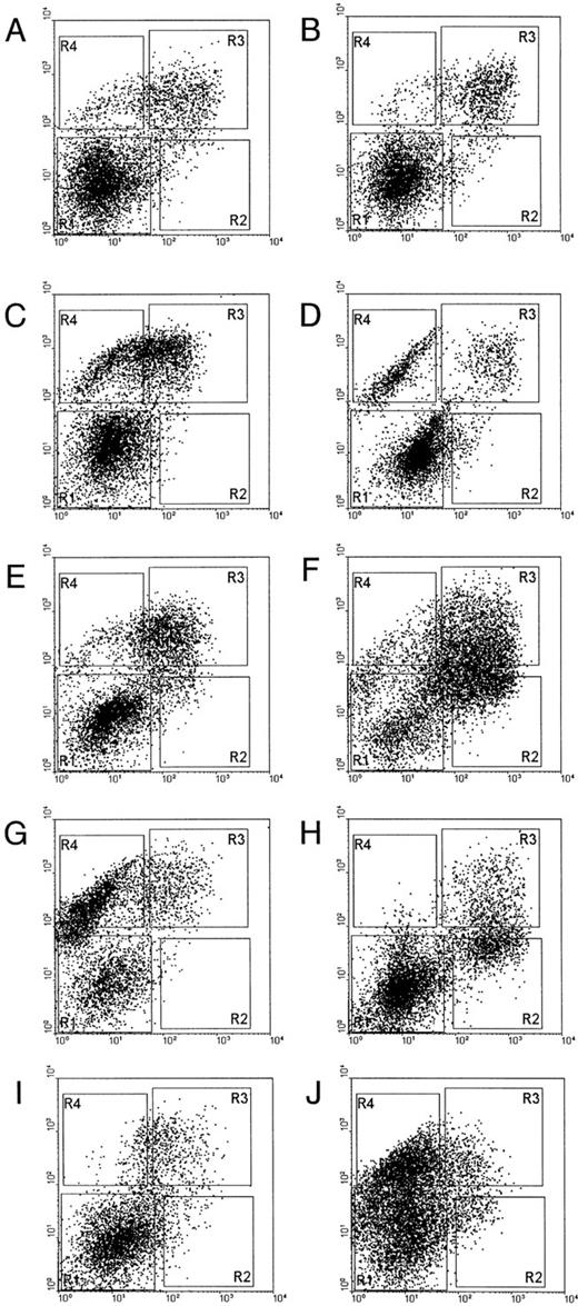 Fig. 6. Flow cytometric analysis of NBM and MDS patient marrow cells. Marrow cells were labeled with CD71-FITC (horizontal axis) and GPA/RAM-PE (vertical axis). (A and B), NBM samples; (C), patient 13; (D), patient 17; (E), patient 8; (F ), patient 1; (G), patient 2; (H), patient 6; (I), patient 16; (J), patient 7. Patient numbers correlate to case numbers in Table 1.