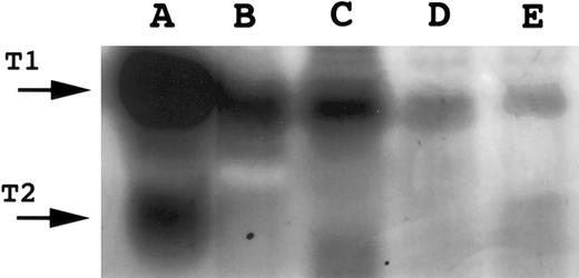 Fig. 2. Reverse zymography for TIMP-1. A total of 15 μL of conditioned media was electrophoresed on 15% SDS polyacrylamide gels containing gelatin and HT1080 fibroblast culture-conditioned media. SDS was removed following electrophoresis and gels incubated to restore gelatinase activity. Gels were scanned by an AGFA Arcus flatbed scanner. Lane A, HT1080-conditioned media (positive control containing both TIMP-1 and TIMP-2); lane B, AG876; lane C, Jijoye; lane D, PA682; lane E, DW6.