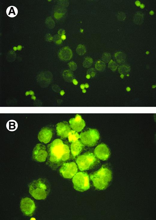 Fig. 3. TIMP-1 and TIMP-2 protein expression. (A) Molt-4 cytocentrifuge preparations stained with rabbit polyclonal anti-TIMP–1 followed by FITC-conjugated goat antirabbit antibodies. Excitation wavelength 490 nm. Original magnification × 630. Small intensely fluorescent structures are debris (too small for cells and no nuclear content on light microscopy). (B) K562 cytocentrifuge preparations stained with rabbit polyclonal anti-TIMP–1 followed by FITC-conjugated goat antirabbit antibodies. Excitation wavelenght 490 nm. Original magnification × 630. (C) Flow cytometric analysis of TIMP-2 expression in K562 cells. Cell number represented on Y-axis and fluorescence intensity on X-axis. Filled in histogram staining with nonimmunized rabbit serum (negative control), clear histogram staining with TIMP-2. Histograms overlap. (D) Flow cytometric analysis of TIMP-2 expression in Jurkat cells. Cell number represented on Y-axis and fluorescence intensity on X-axis. Filled in histogram staining with nonimmunized rabbit serum (negative control), clear histogram staining with TIMP-2.