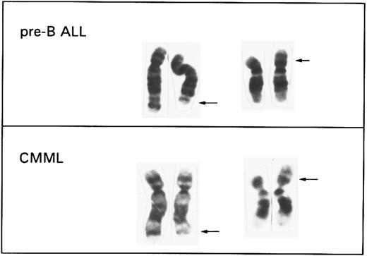 Fig. 1. Comparison of the partial karyotypes of a t(5; 12) (q31q33; p12) associated with a del(5)(q31q33) and a microdeletion (12)(p12) found by FISH in pre-B ALL cell lines and a t(5; 12)(q33; p13) identified in cases with CMML. The arrows indicate the breakpoint regions on each derivative chromosome.