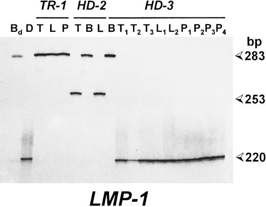 Fig. 2. Patients with EBV-associated lymphoproliferative disorders show identical LMP-1 gene deletions in spontaneous LCLs and neoplastic cells. Polyacrylamide gel electrophoresis (PAGE) analysis of radioactive PCR products corresponding to the carboxy terminus of the LMP-1 gene. For each case, the results of the analysis of pathologic biopsy specimens (T) and of spontaneous LCLs derived from the lesion (L) or PBMCs (P) are reported. B95.8-induced LCLs were also investigated in cases HD-2 and HD-3 (B). Bd , DNA from an LCL derived from a healthy donor by transformation with the B95.8 EBV strain; (D) DNA from an EBV+ HD carrying a deleted LMP-1 gene. Sizes are in base pairs.